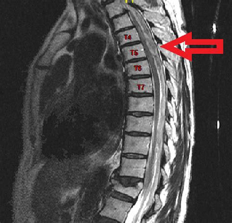 Cureus | Spontaneous Spinal Subdural Hematoma Mimicking Myocardial ...