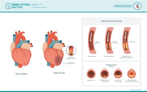 Coronary Artery Disease: A Deep Dive into Causes and Treatments - Longmore Clinic