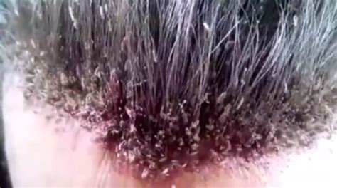 Lice Bugs In Hair