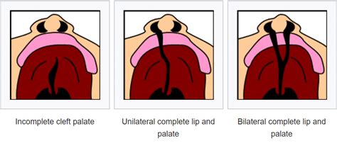 The Palate - Hard Palate - Soft Palate - Uvula - TeachMeAnatomy