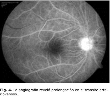 Síndrome isquémico ocular