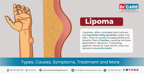 Lipoma: Types, Causes, Symptoms, Treatment, and More