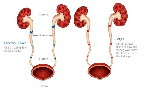 Vesicoureteral Kidney Reflux Information