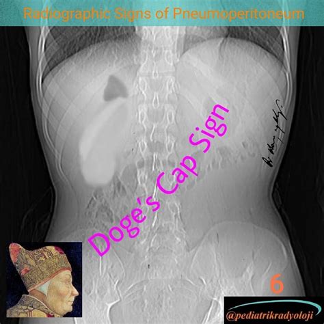 - P156 - Radiographic Signs of Pneumoperitoneum - 8 . Radiological Illustration - 6 . Doge’s cap ...