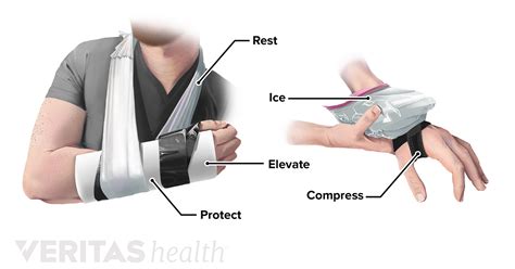 Treating Wrist Sprains