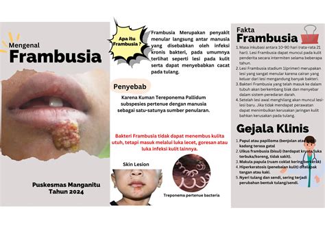 Mengenal Frambusia dan gejala yang ditimbulkan | PPT