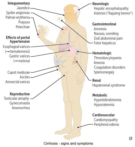 Liver Cirrhosis Symptoms