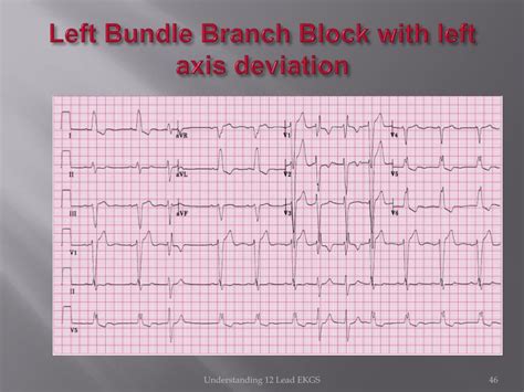 PPT - ECG SIGNAL RECOGNIZATION AND APPLICAITIONS PowerPoint ...