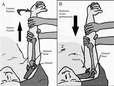 Reduction of Anterior Shoulder Dislocations by Spaso Technique: Clinical Results - Journal of ...