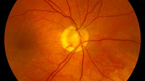 Gene Therapy for inherited retinal diseases - The Snow Foundation