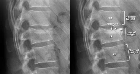 Compression Fracture