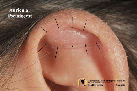 Auricular Pseudocyst: Treating with buttons - Academic Dermatology of Nevada