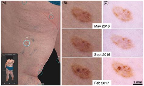 Frontiers | Clinical Perspective of 3D Total Body Photography for Early Detection and Screening ...