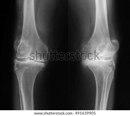 Bilateral Osteoarthritis Knee Joint Xray Image Stock Photo (Edit Now) 491639905 - Shutterstock