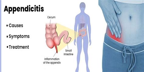 Appendix Pain Location