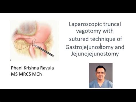 Laparoscopic truncal vagotomy with sutured technique of gastrojejunostomy and JJ PhaniKrishna ...