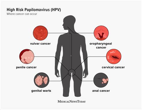 High risk HPV: Types, treatments, and more