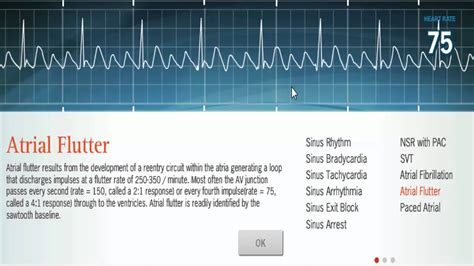 Atrial flutter vs afib ecg - sterbery