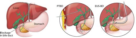 Percutaneous Biliary Drain Nursing Care - Best Drain Photos Primagem.Org