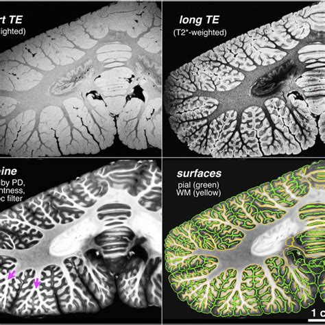 Coronal high-resolution MRI images of the human cerebellum. Short-and... | Download Scientific ...