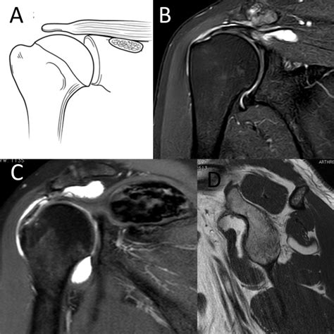 Shoulder:Rotator Cuff Pathology/Thickness Rotator Cuff Tears/Posterosuperior Rotator Cuff ...