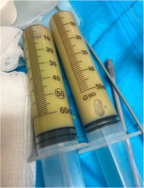 Purulent pleural fluid drained on day of presentation to pleural clinic. | Download Scientific ...