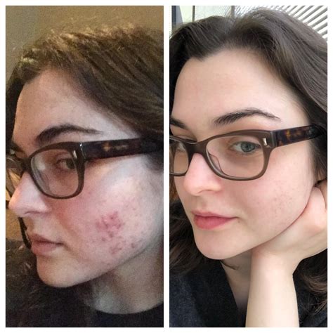 [B&A] 18 months progress hormonal cystic acne : r/SkincareAddiction