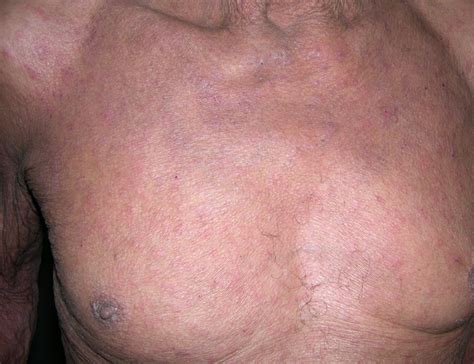 scabies on chest - pictures, photos