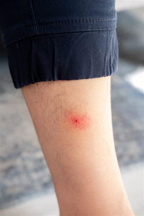 7 Symptoms of a Tick Bite | Springborough Pharmasave