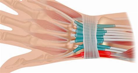 Wrist Tendonitis - Symptoms, Causes, Treatment & Rehabilitation