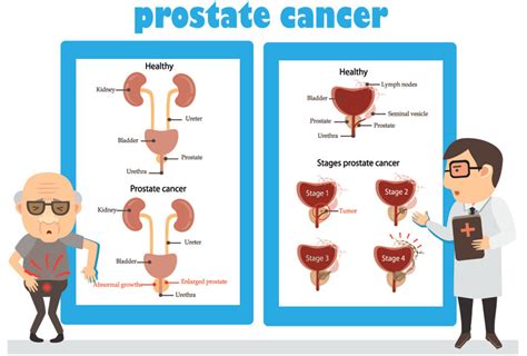 Everything You Need to Know About Prostatectomy