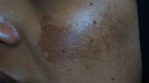 Discolored Skin Patches: Pictures, Causes, and Treatments