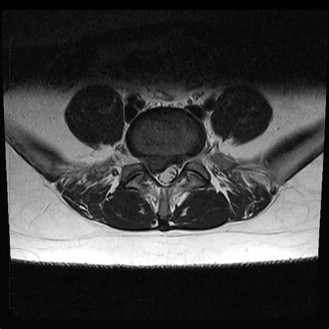 MRI of the Lower Back | Melbourne Radiology