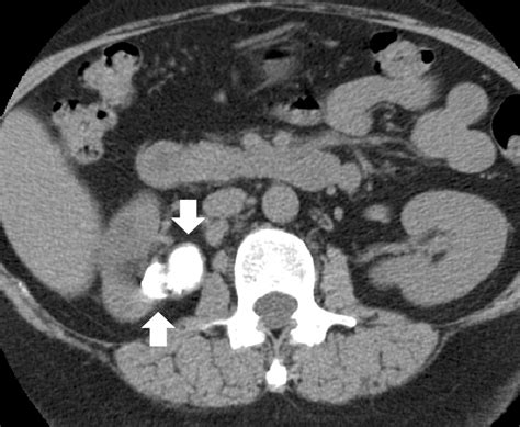 Renal Tuberculosis | RadioGraphics