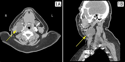 Branchial Cleft Cyst Harbors Metastatic Papillary Thyroid Carcinoma | Cureus