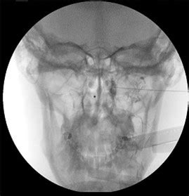 Sphenopalatine Ganglion Blocks and radiofrequency ablation | Solutions In Pain