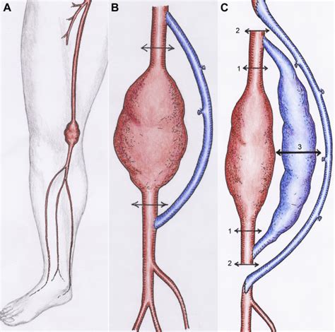 An Aneurysmal Degeneration of Venous Bypass for Popliteal Artery Entrapment Syndrome - Annals of ...