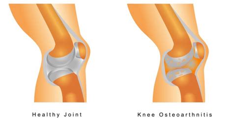 Partial vs. Total Knee Replacement Surgery | DOC Blog