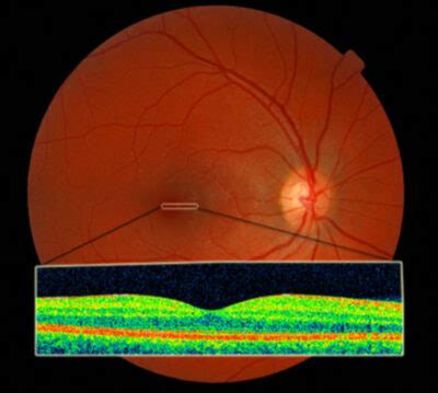 Oct 3D Retinal Scan – Early and Edmonds Opticians