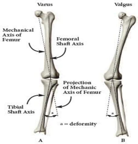 Measurement of Deformity | Download Scientific Diagram