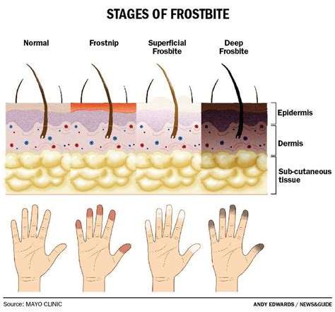 Do you know all you need to about frostbite? - Bebout Family Medicine