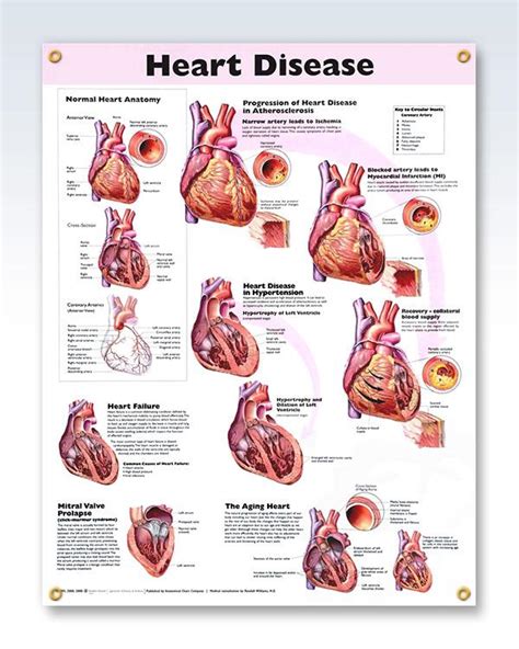 Heart disease chart 20×26 – Artofit