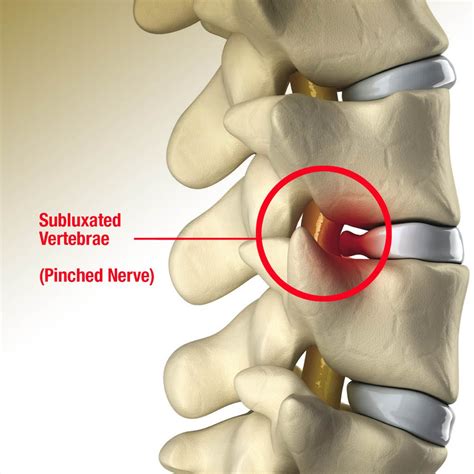 The Single Strategy To Use For Pinched Nerve In My Back | Nerve Zone