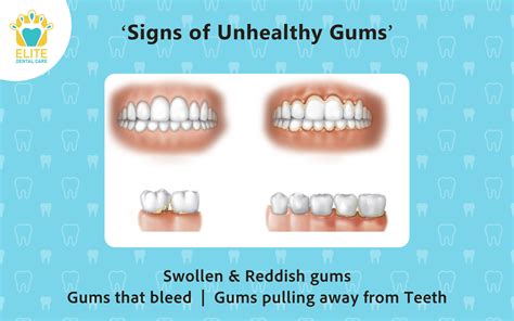 SIGNS OF UNHEALTHY GUMS | Elite Dental Care