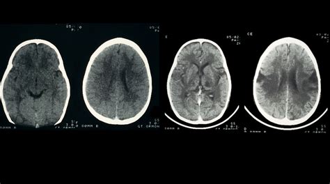 Encephalitis: the rare disease with a million implications