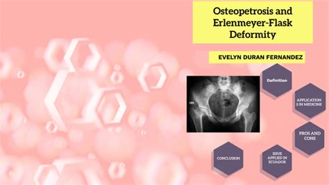 Osteopetrosis and Erlenmeyer-Flask Deformity by Evelyn Estela Duran Fernandez on Prezi