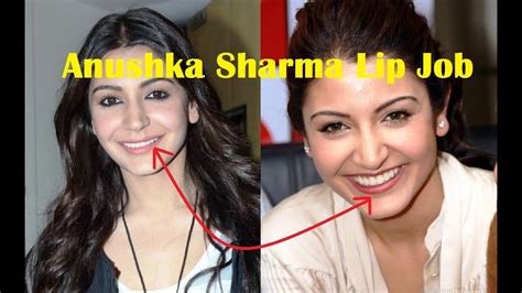 Anushka Sharma Plastic Surgery Before After DISASTER !! - YouTube