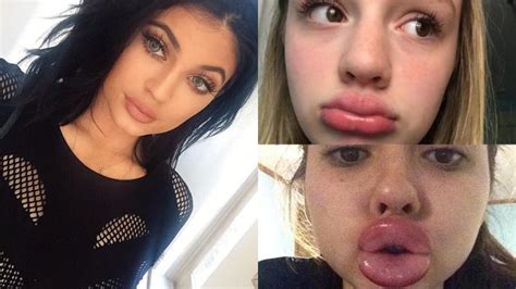 Kylie Jenner Lip Challenge: “Pout” of control? – Etched in Stone