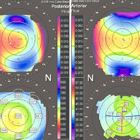 Orbscan showing. (a) Normal picture in the right eye. (b) Forme fruste... | Download Scientific ...