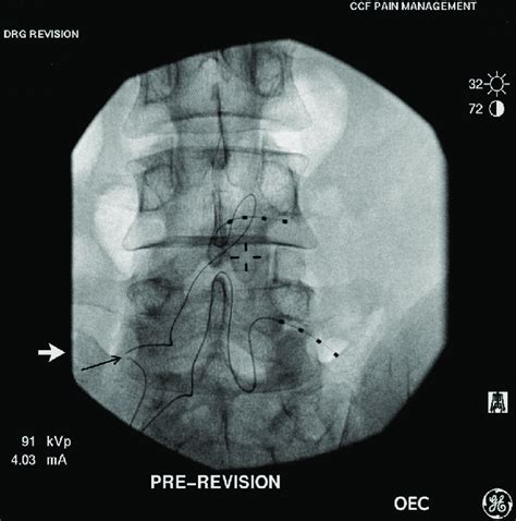 Intact dorsal root ganglion (DRG) stimulator at the right L4 and L5... | Download Scientific Diagram